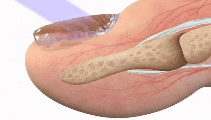 CONCLUSION: PODOclear Wipes Out Fungus Unlike Anything Else We’ve Seen