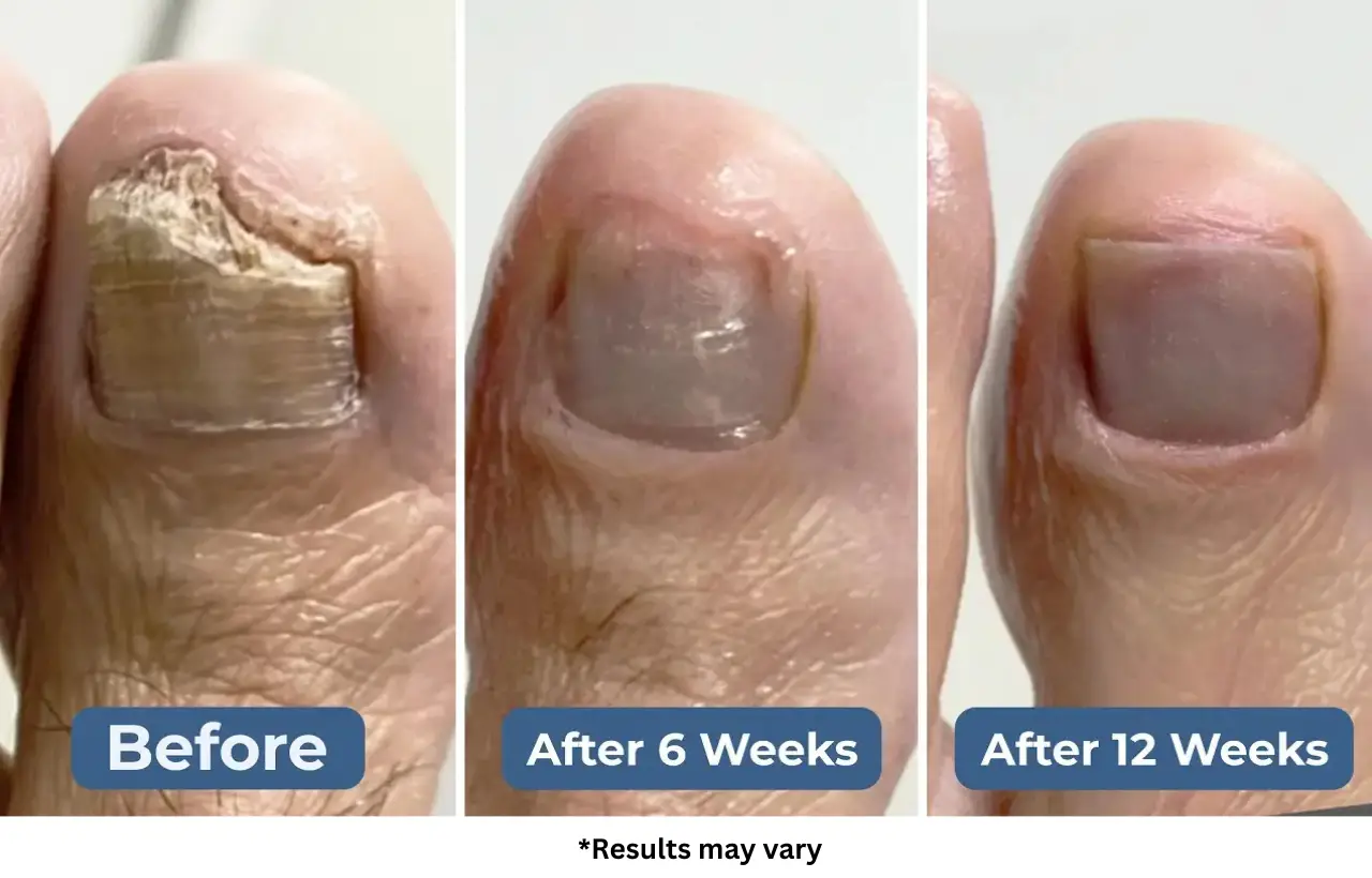 Case #3: An Athlete Crippled by Toenail Fungus Is Running Again After 10 Weeks
