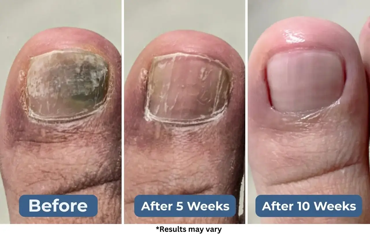 Case #2: A 62-Year-Old Woman Canceled Surgery and Wiped Out Fungus in 5 Weeks